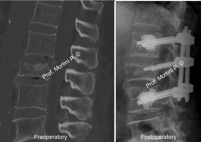 Minimally Invasive Spinal Fusion